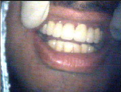 After Treatment